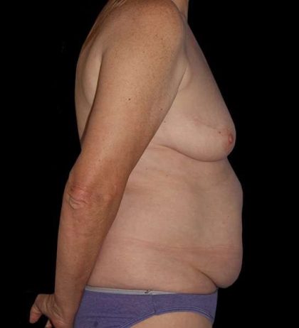 DIEP Flap Before & After Patient #2943