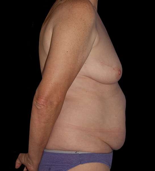 DIEP Flap Before & After Patient #2943