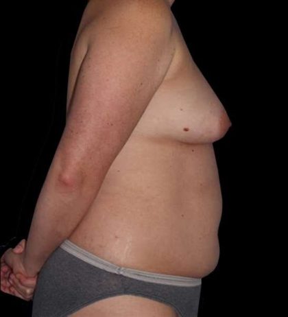 DIEP Flap Before & After Patient #2954