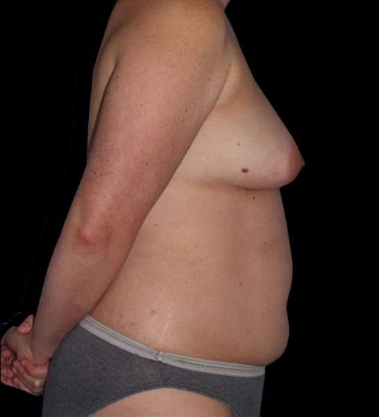 DIEP Flap Before & After Patient #2954
