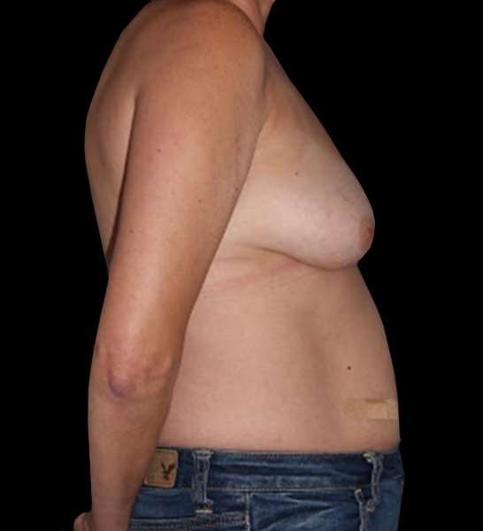DIEP Flap Before & After Patient #2962