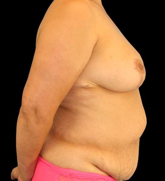 DIEP Flap Before & After Patient #2974