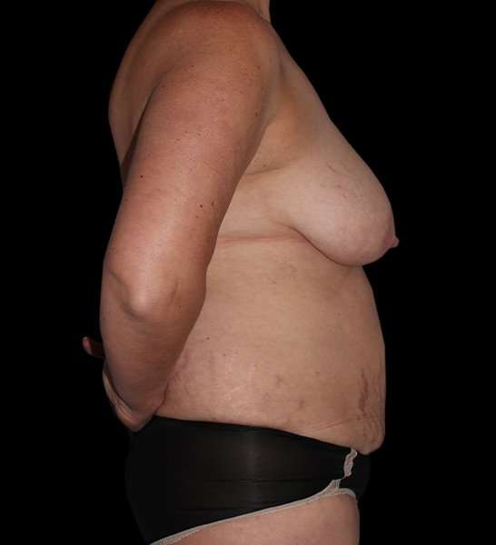 DIEP Flap Before & After Patient #2989