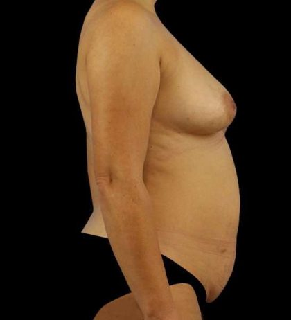 DIEP Flap Before & After Patient #3004