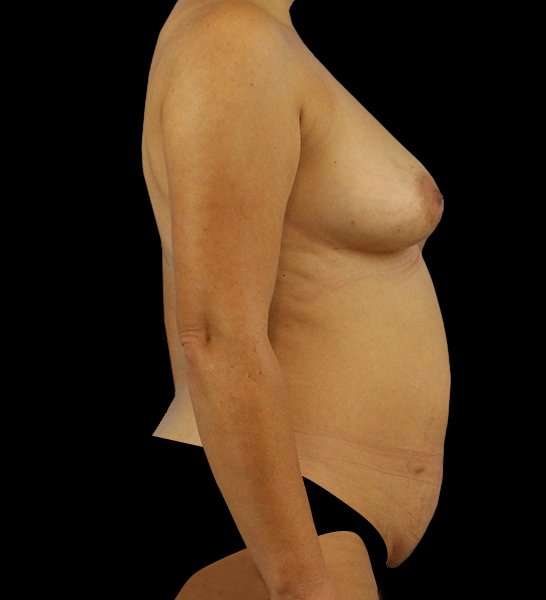 DIEP Flap Before & After Patient #3004