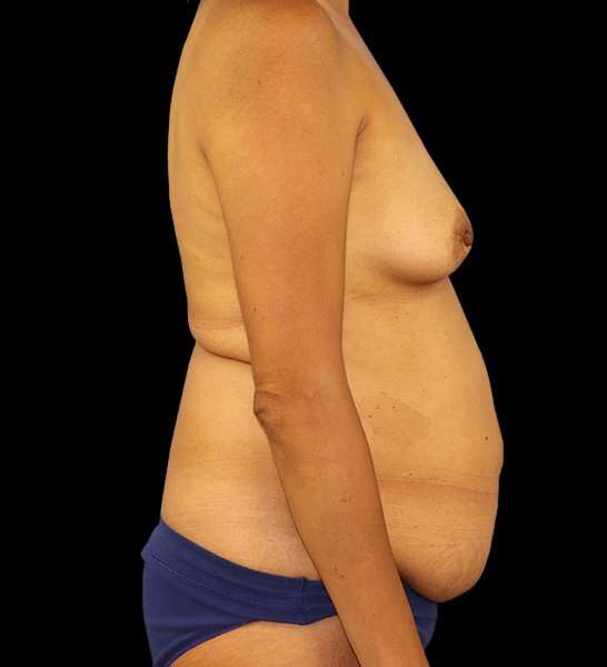 DIEP Flap Before & After Patient #3019