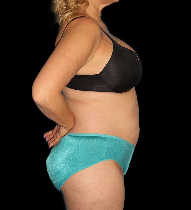 Abdominoplasty (Tummy Tuck) Before & After Patient #579