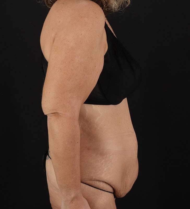 Abdominoplasty (Tummy Tuck) Before & After Patient #817