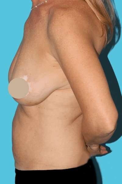DIEP Flap Before & After Patient #3096