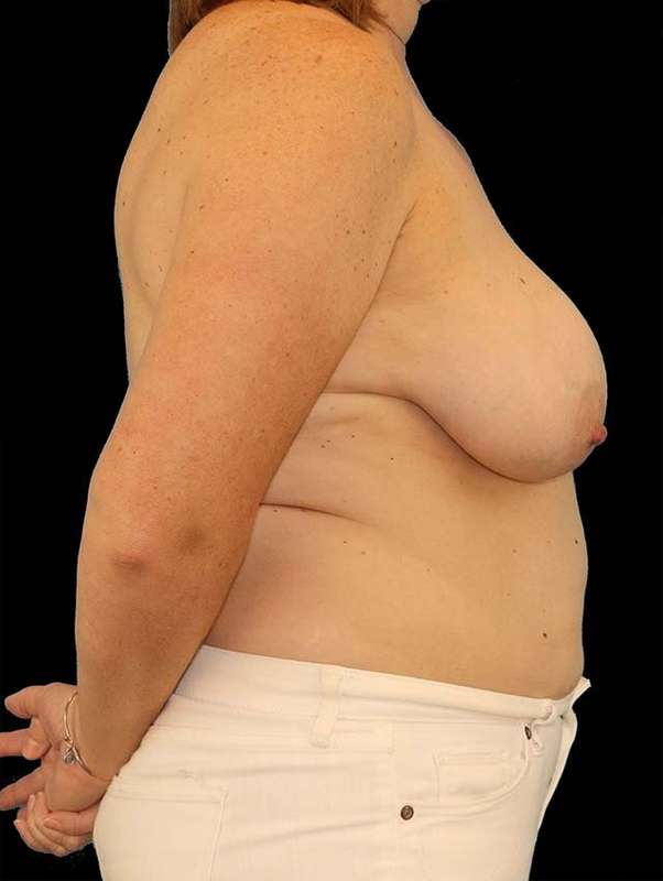 DIEP Flap Before & After Patient #3110