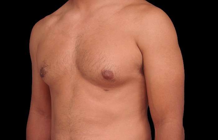 Gynecomastia Before & After Patient #3130