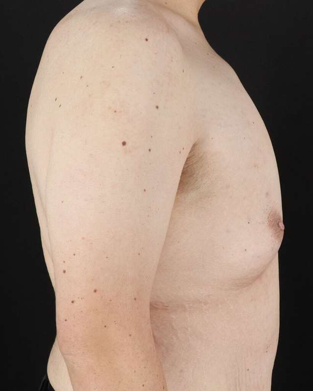 Gynecomastia Before & After Patient #3162