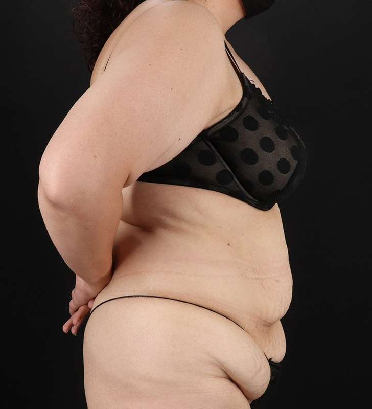 Abdominoplasty (Tummy Tuck) Before & After Patient #830