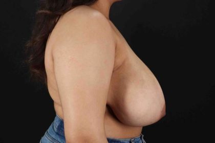 Breast Reduction With Lift Before & After Patient #3301