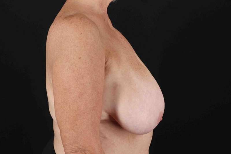 Breast Reduction With Lift Before & After Patient #3312