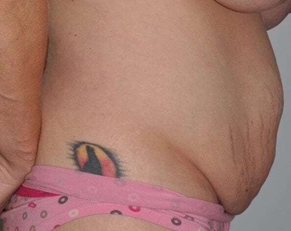 Abdominoplasty (Tummy Tuck) Before & After Patient #855