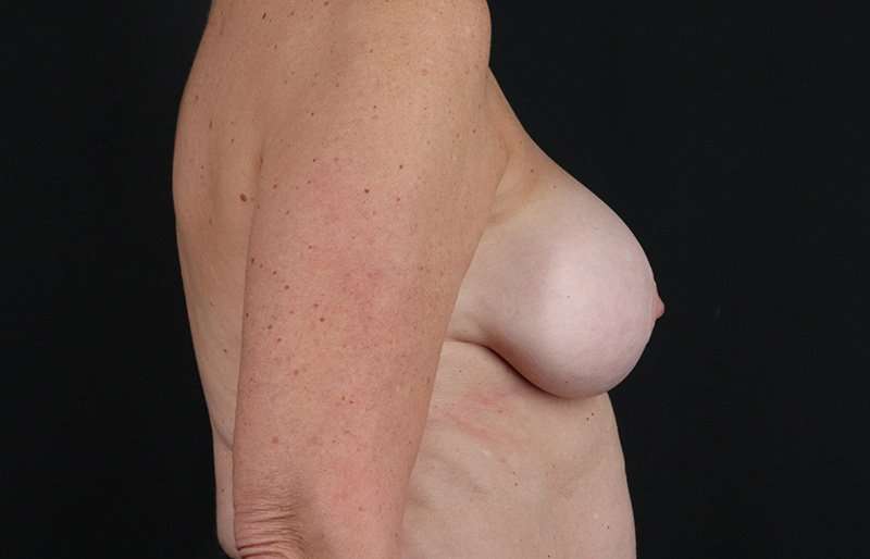 Breast Implant Removal Before & After Patient #3505