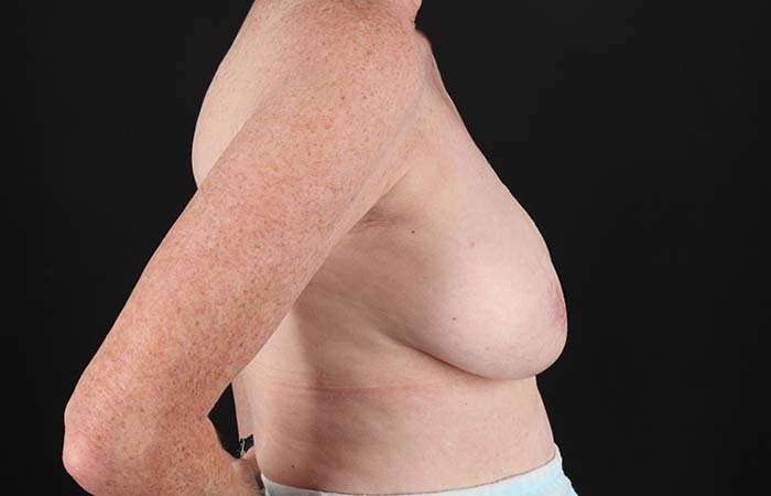 Implant Based Reconstruction Before & After Patient #3527
