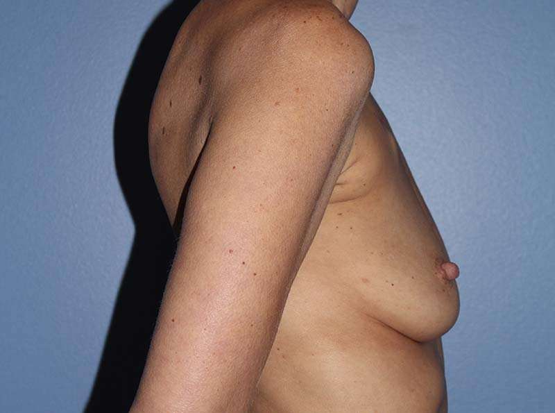 Implant Based Reconstruction Before & After Patient #3538