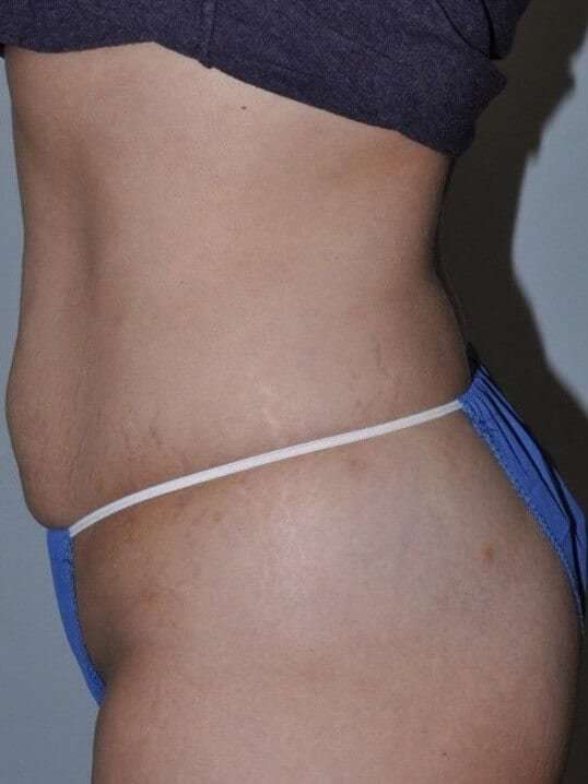 Abdominoplasty (Tummy Tuck) Before & After Patient #862