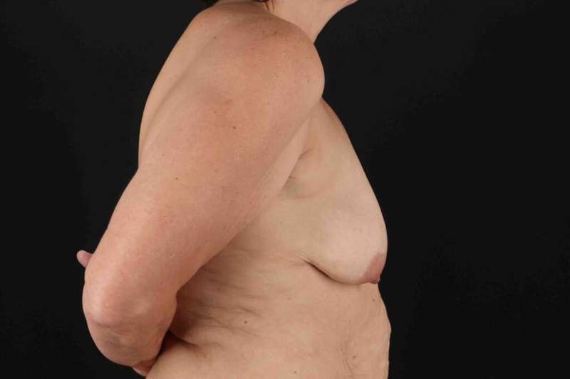 Breast Lift Before & After Patient #3571