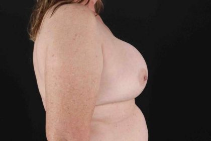 Breast Lift Before & After Patient #3593