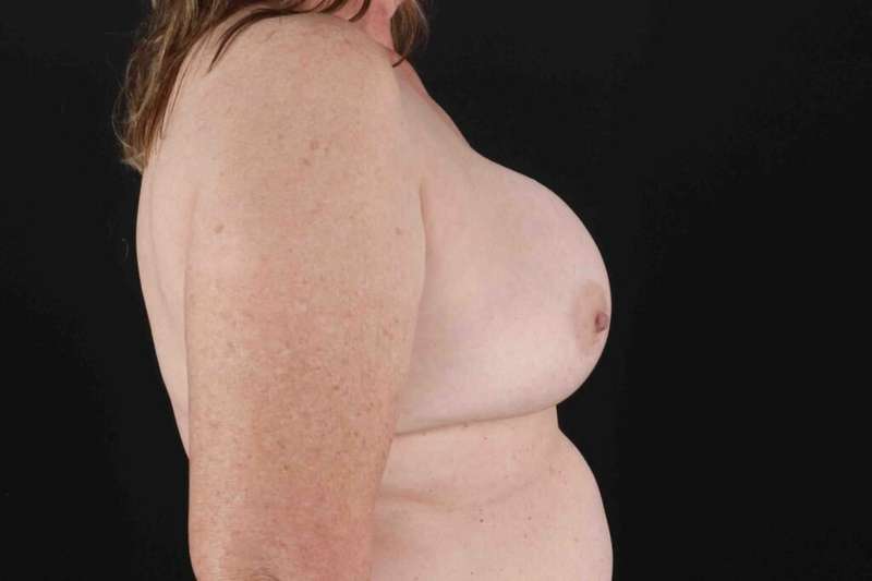 Breast Lift Before & After Patient #3593