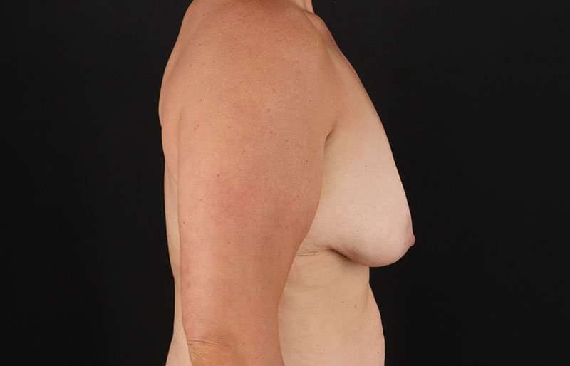 Breast Lift Before & After Patient #3615