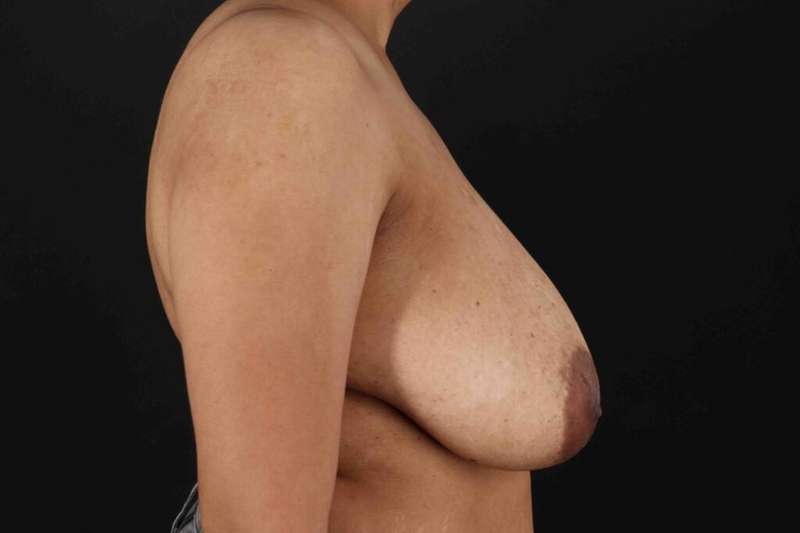 Breast Lift Before & After Patient #3626