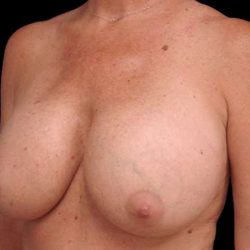 Breast Lift Before & After Patient #3633