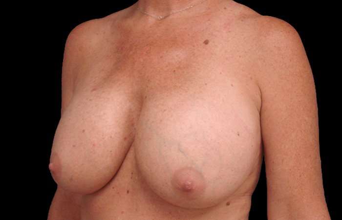 Breast Lift Before & After Patient #3633