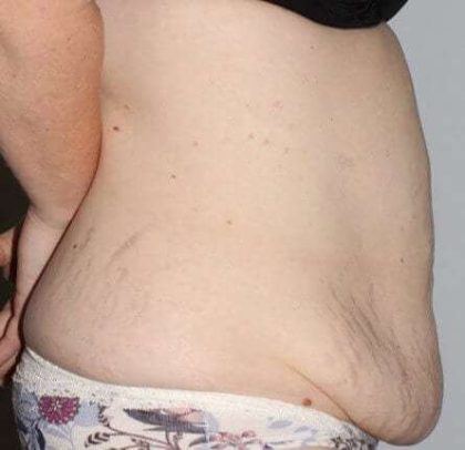 Abdominoplasty (Tummy Tuck) Before & After Patient #874