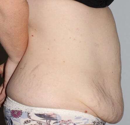 Abdominoplasty (Tummy Tuck) Before & After Patient #874