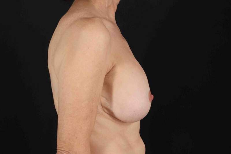 Breast Lift Before & After Patient #3662