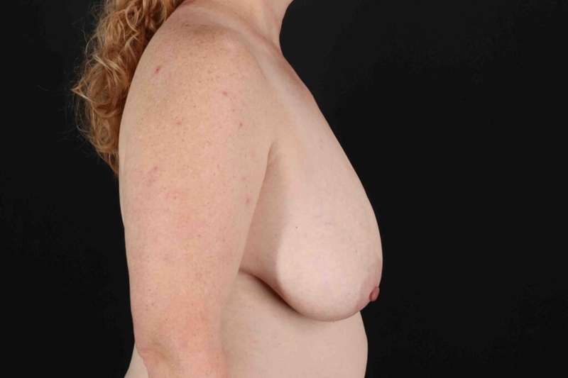 Breast Lift Before & After Patient #3684
