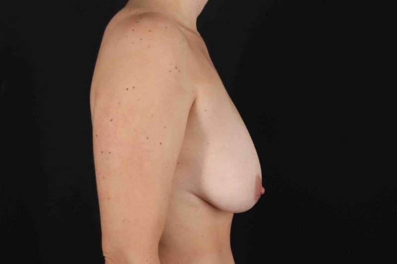 Breast Lift Before & After Patient #3695