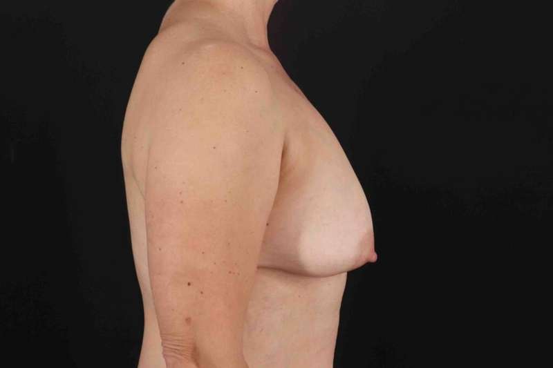 Breast Lift Before & After Patient #3706