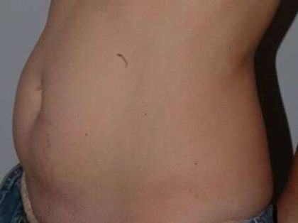 Abdominoplasty (Tummy Tuck) Before & After Patient #881