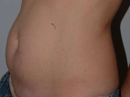 Abdominoplasty (Tummy Tuck) Before & After Patient #881