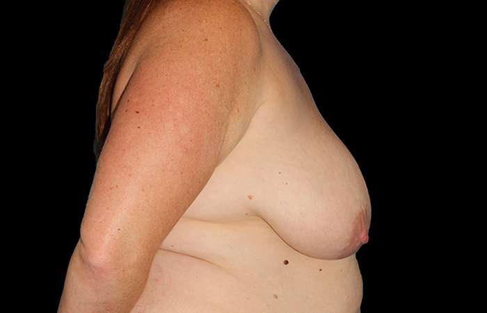 Breast Lift Before & After Patient #3761