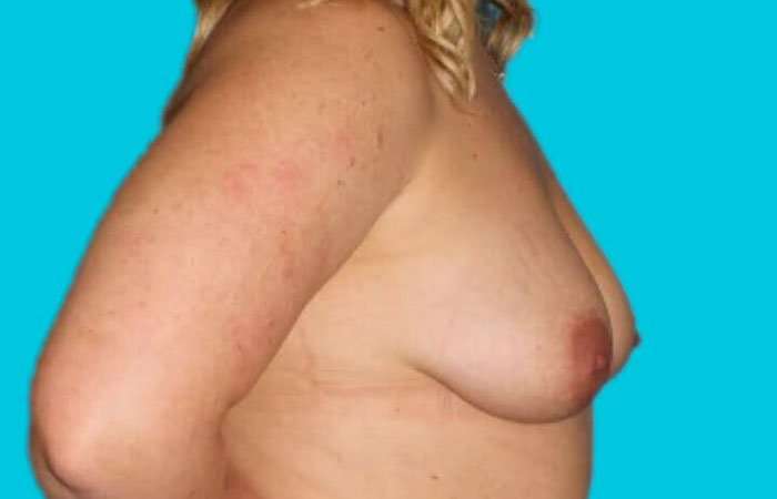 Breast Lift Before & After Patient #3779