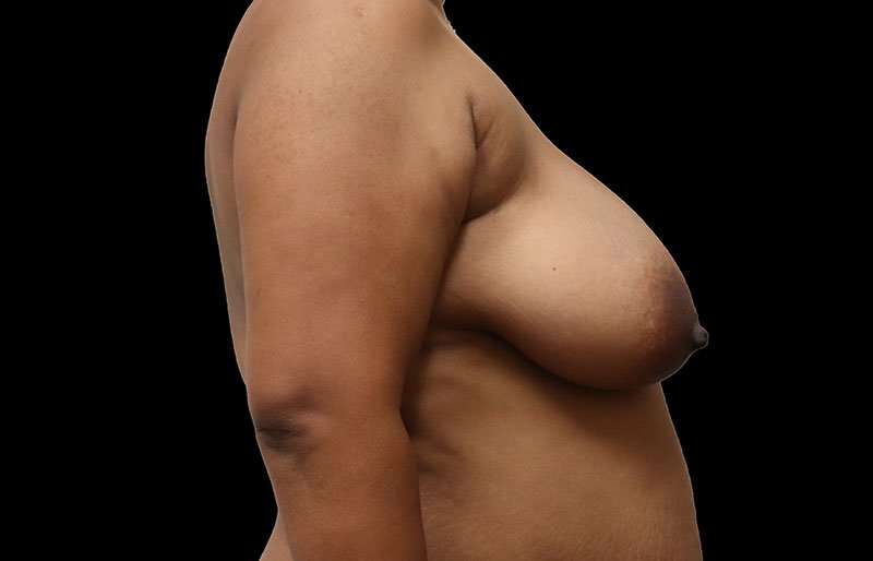 Breast Lift Before & After Patient #3820
