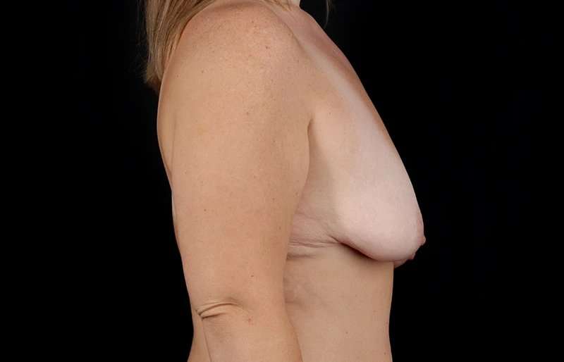 Breast Lift Before & After Patient #3831