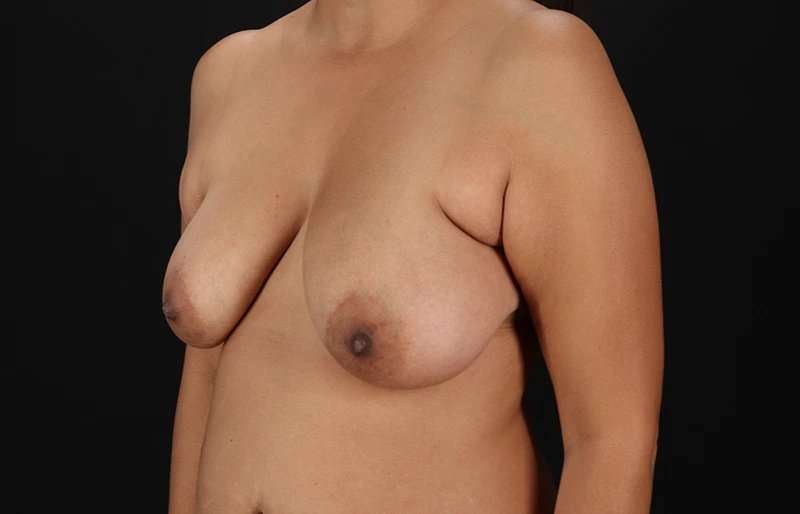 Breast Lift Before & After Patient #3840