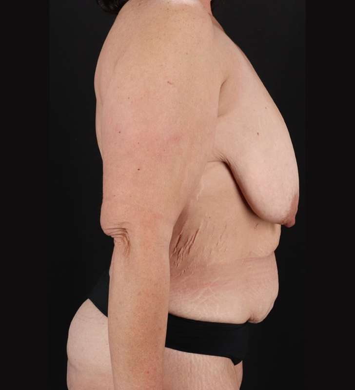 Breast Lift Before & After Patient #3853