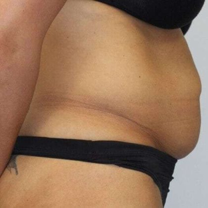 Abdominoplasty (Tummy Tuck) Before & After Patient #889