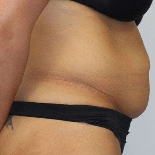 Abdominoplasty (Tummy Tuck) Before & After Patient #889