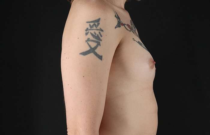 Male To Female Breast Before & After Patient #3886