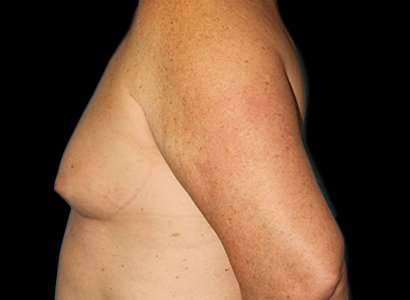 Male To Female Breast Before & After Patient #3893