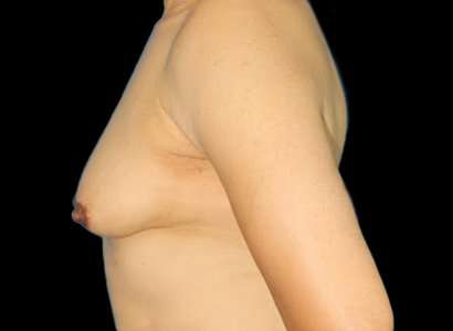 Male To Female Breast Before & After Patient #3900